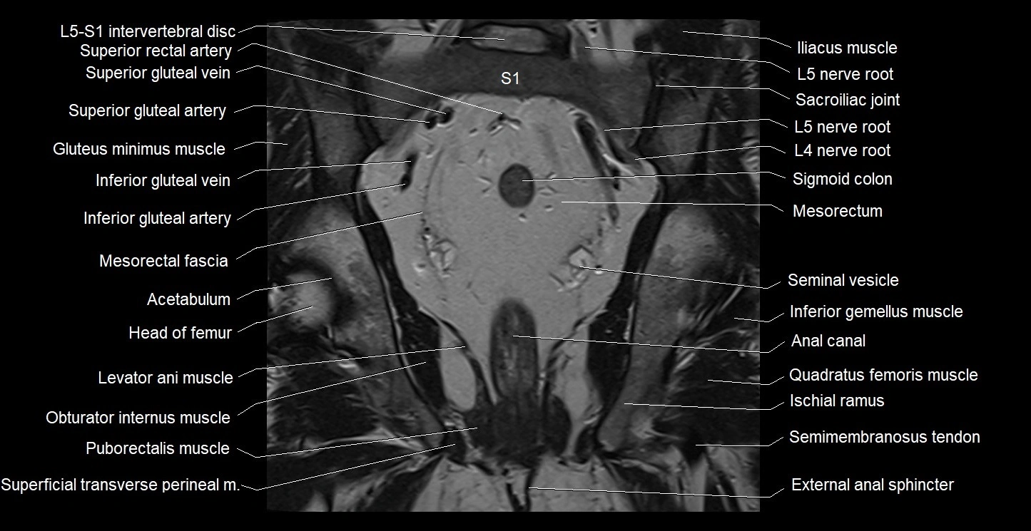 MRI coronal cross sectional anatomy male pelvis image 25.webp